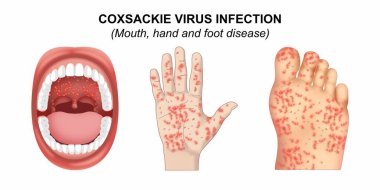 Coxsackie Virüsü Ağız El ve Boğaz Hastalığı