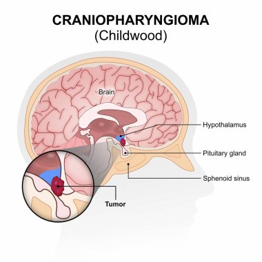 Çocukluk Craniopharyngioma Beyin Tümörü Çizimi