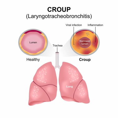 Croup - Akut Laryngotracheobronşit İllüstrasyonu