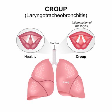 Croup - Akut Laryngotracheobronşit Ses Kordonu İllüstrasyonu