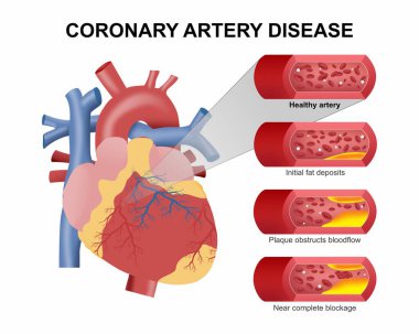 Koroner Arter Hastalığı Kalp İllüstrasyonu
