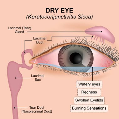 Kuru Göz - Keratokonjunctivitis Sicca, işaret ve belirtiler