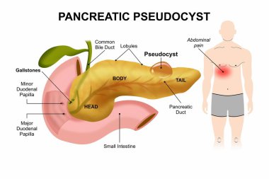 Pankreas Pseudocyst, pankreas illüstrasyonunda sıvı dolu kese
