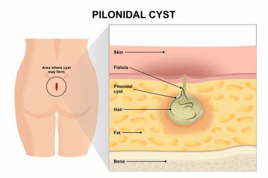 Pilonidal Cyst, Sinus Illustration Fluid-filled