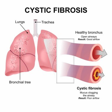 Kistik fibrozis mukusu bronşları tıkamış.