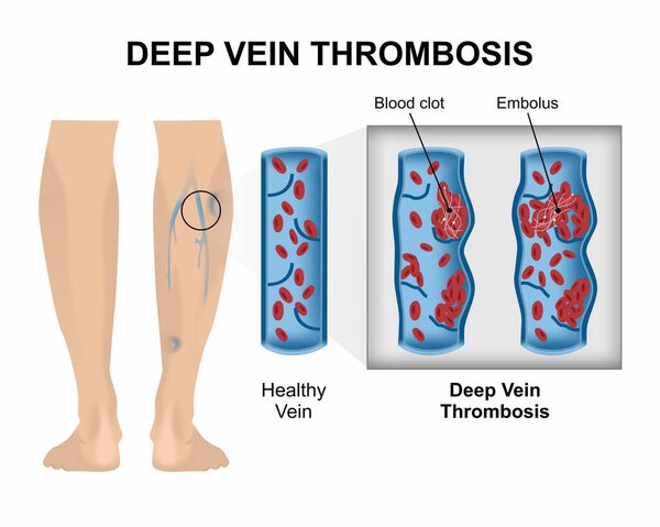 Глубокий тромбоз вен (DVT)