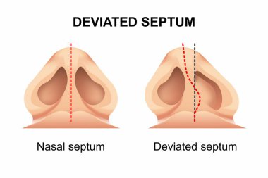 Saptırılmış Septum Burun Cerrahisi Çizimi