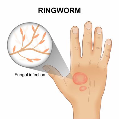 Mantar mantarı enfeksiyonu.