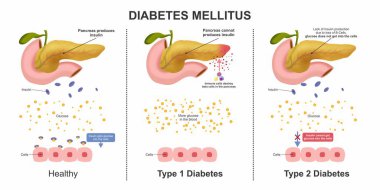 Diyabet Mellitus tipi diyabet.