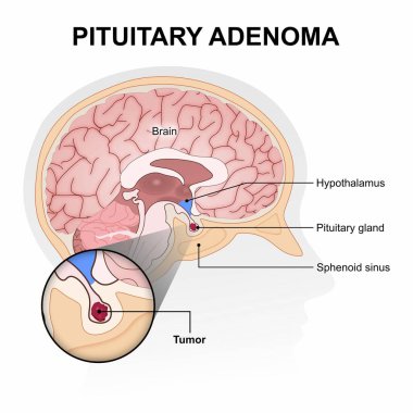 Hipofiz Adenom, Hipofiz Tümörleri Çizimi