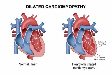 Genişletilmiş Kardiyomiyopati (Genişletilmiş Kalp) İllüzyon