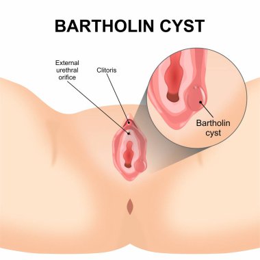 Bartholin kist bezi çizimi