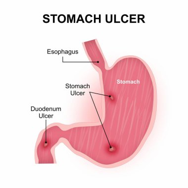 Mide Ülseri - Duodenum Ülser flash kart çizimi