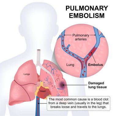 Pulmoner embolizm Akciğer Akciğeri Tıbbi Flashcard Çizimi