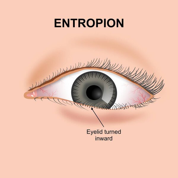 Entropion eye flashcard medical illustration