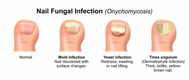 Tırnak Mantarı Enfeksiyonu (Onychomycosis)