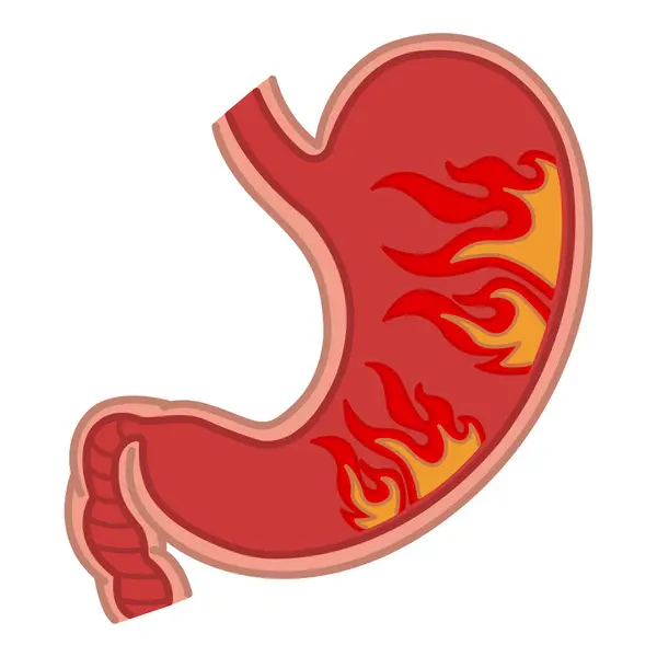Gastritis Del Estómago Concepto Acidez Ilustración Vectorial Estómago Humano Llamas — Vector de stock
