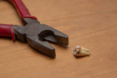 Kayıp diş çürüğü ve pense.