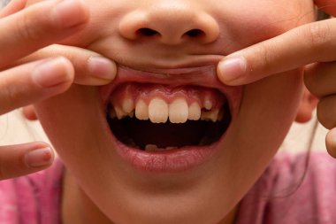 Dişleri dökülmüş bir çocuğun ağzı.