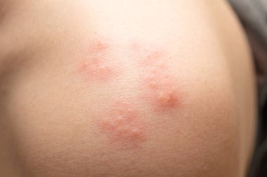 Saç solucanları tarafından bıçaklanan iltihaplı deri.