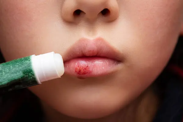 A child who applies lip balm to rough lips