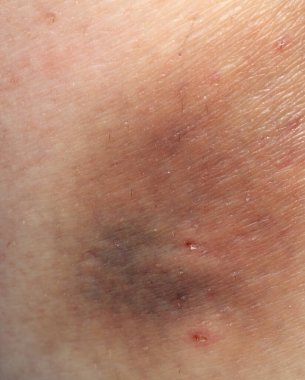 Çelme takıp düşmekten vücudundaki büyük bir çürüğe yakın çekim.