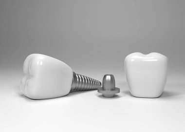 Diş implantı ameliyatı 3D görüntüleme