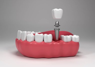 Photo dental implants surgery 3d rendering clipart