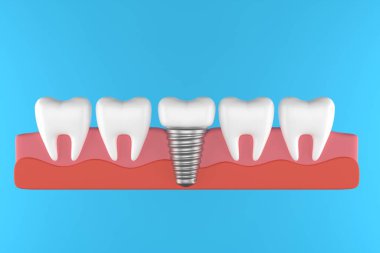 Fotoğraf implantı dişçi metal vida