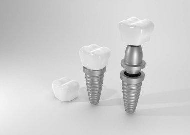 Diş implantı olan beyaz bir arka plan.