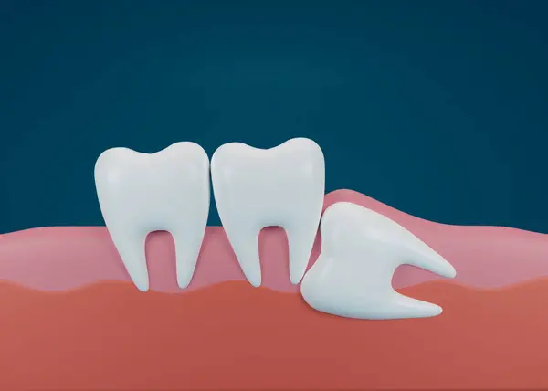 Photo 3d render of teeth with wisdom mesial impaction