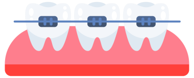 Diş, ortodontik tedavi. Dişlerinde diş telleri. Diş sağlığı sigortası. resimleme.