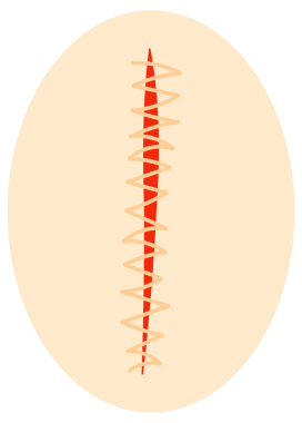 Farklı şekillerde çeşitli dikiş yaralarını temsil eden yuvarlak simgelerin toplanması, cerrahi dikiş iyileşme sürecini gösteriyor