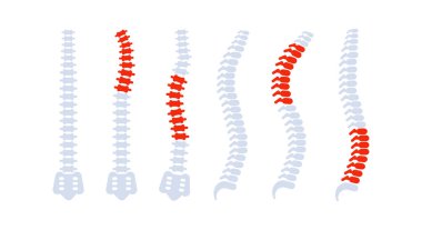 Sırt ağrısı olan insan omurgası kemikleri farklı sorunlar ve kıvrımlar gösteriyor.