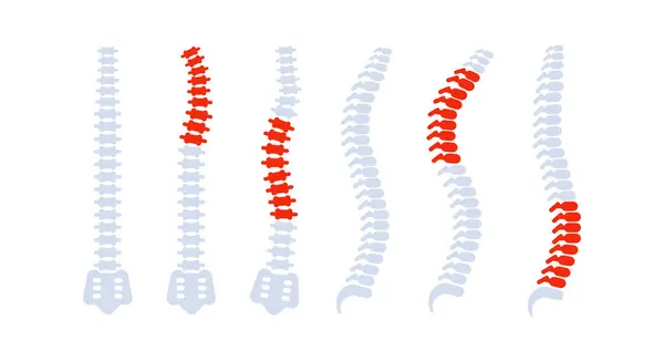 Sırt ağrısı olan insan omurgası kemikleri farklı sorunlar ve kıvrımlar gösteriyor.