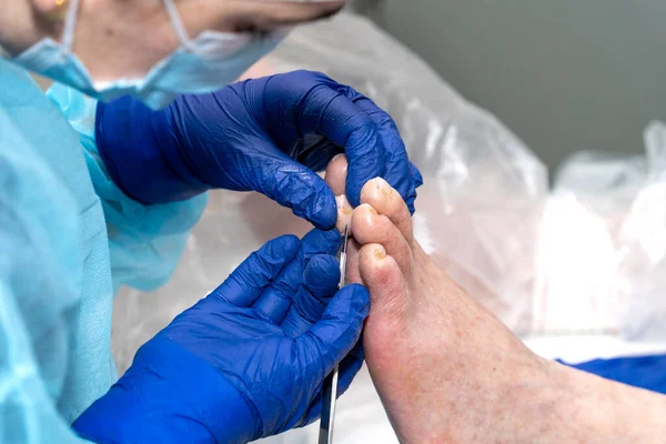 Podiatrist Removing Cuticle Dry Skin Elderly Patients Toenails Clinic While — Stock Photo, Image