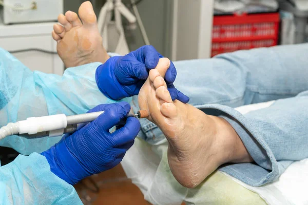 Podologe Verwendet Medizinisches Schmirgelbrett Trockene Haut Vom Fuß Des Patienten — Stockfoto