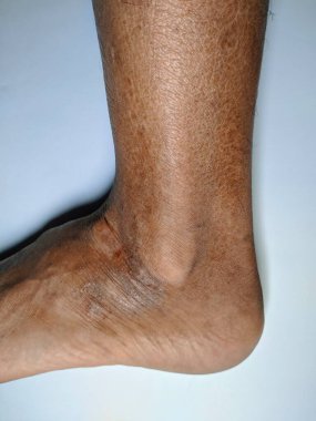 Close-up of a diabetic foot with visible skin discoloration and possible edema, showcasing the potential complications of diabetes. clipart