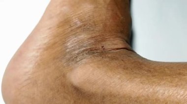 Diyabet hastalarının ayaklarındaki deriye yakından bakıldığında, diyabetin olası komplikasyonlarına işaret eden ödem olabilecek renk bozukluğunun yol açtığı çatlaklar görülüyor..