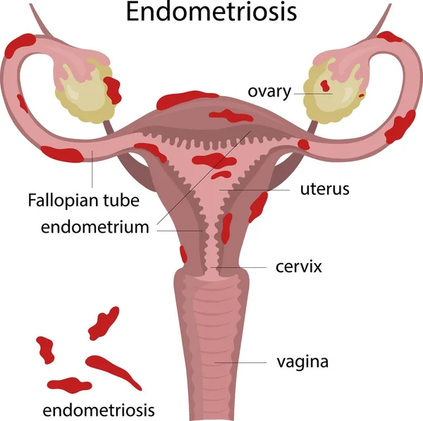 Endometriyozis. Jinekolojik hastalık. Rahimde iltihap var. Kadın organları hastalıkları.