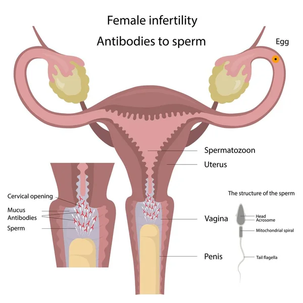 Vektör illüstrasyon kadın kısırlığı. Sperme karşı antikorlar.