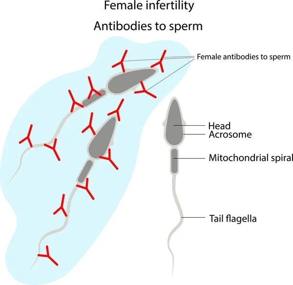 Infertilidad Femenina Anticuerpos Esperma Estructura Del Esperma — Vector de stock