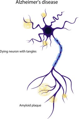 Hasarlı bir nöronun vektör çizimi. Hastalıklı bir nöronun yapısı. Alzheimer hastalığı. Beyin hastalıkları, hafıza bozuklukları..