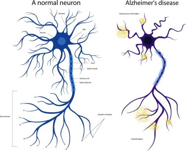 Hasta ve sağlıklı bir nöron. Hasarlı nöron. Alzheimer hastalığı. Beyin hastalıkları, hafıza bozuklukları. Alzheimer hastalığında bir nöron
