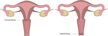 Rahimde gelişimsel malformasyonlar, vajinal atrezi ve rahim atrezisi..