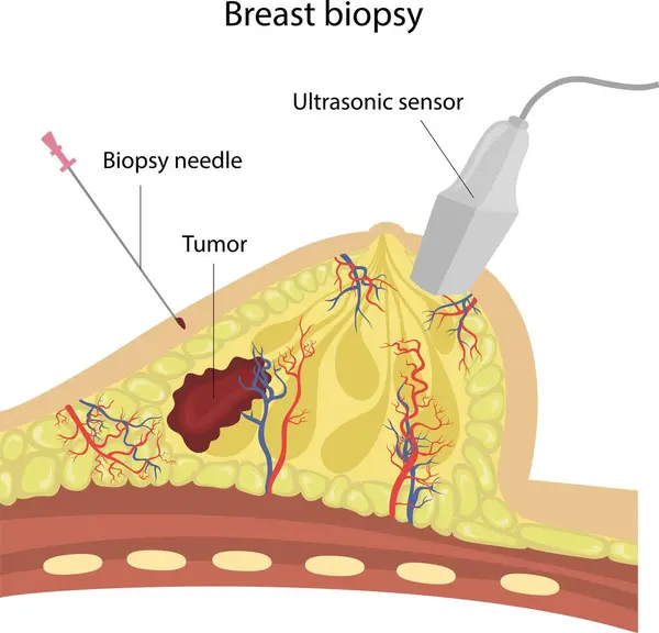 Göğüs biyopsisi. Göğüs hastalığının teşhisi.