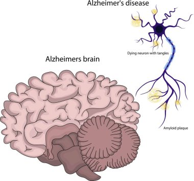 Alzheimer hastası bir beynin vektör çizimi.