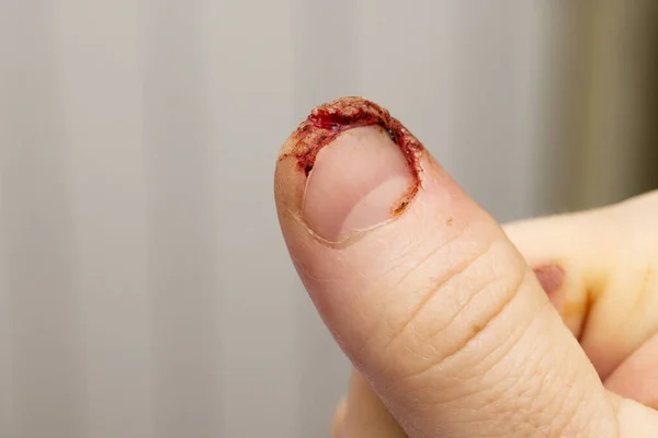 Physical injury of hand finger. Fresh wound with blood on male finger.