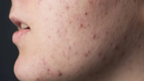 Yüzünde sivilce var. Deri dokusu. Yakın akne derisi. Cilt tedavisi. Cilt bakımı sorunu. Sivilceler, sivilceler, gözenekler, yaralar. Cilt bakımı. Sivilce tedavisi yüzünde sivilceler