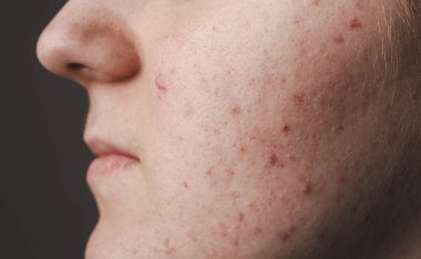 Yüzünde sivilce var. Deri dokusu. Yakın akne derisi. Cilt tedavisi. Cilt bakımı sorunu. Sivilceler, sivilceler, gözenekler, yaralar. Cilt bakımı. Sivilce tedavisi. Yüzünde sivilceler